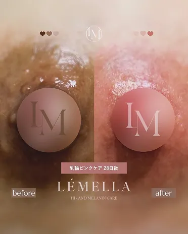 ルメラ | 大阪市西区 北堀江の美容皮膚科・美容内科 | UNI CLINIC
